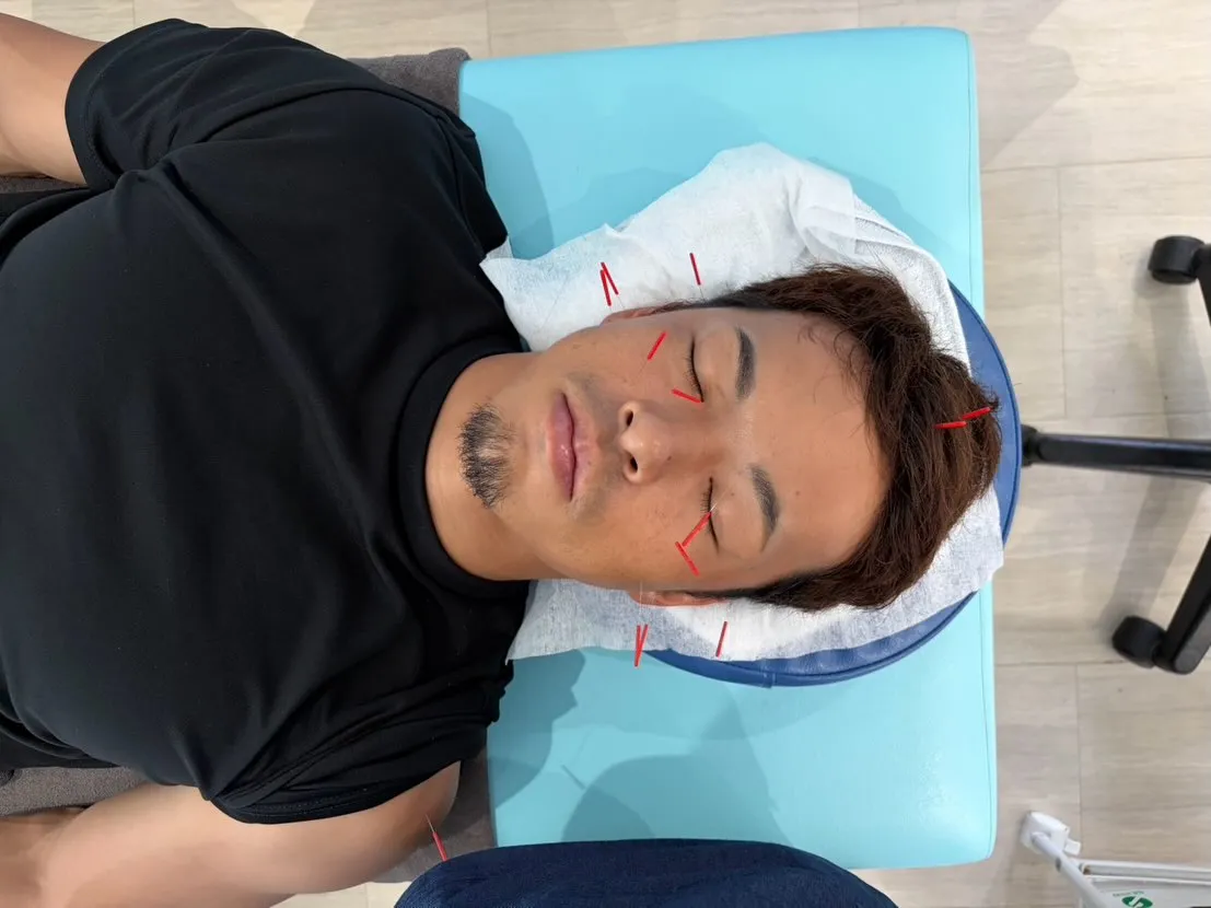 男性にも人気！顔の鍼✨