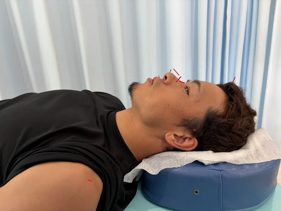 男性にも人気！顔の鍼✨